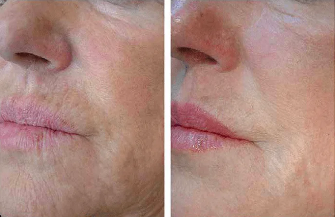 Profhilo Injection Treatment before and after