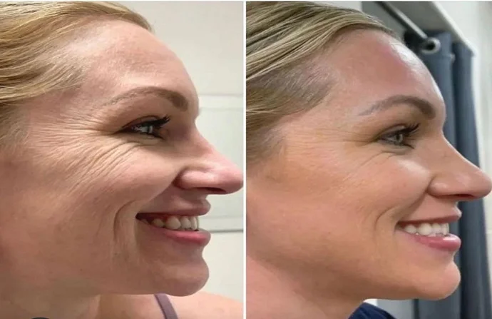 Profhilo Injection Treatment before and after