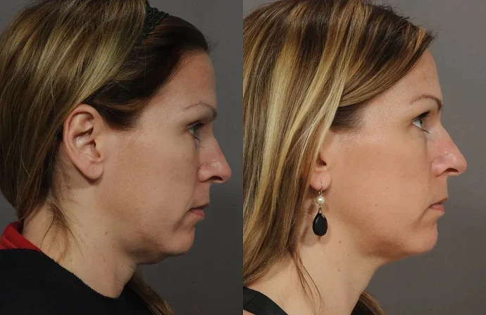 Ultertherapy Treatment before and after