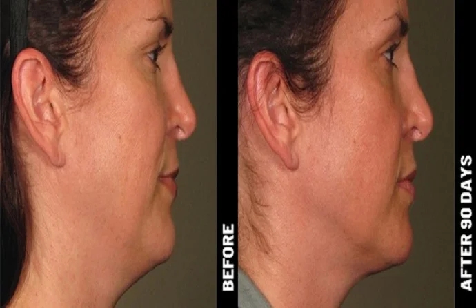 Ultertherapy Treatment before and after