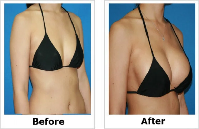 AFT Breast Augmentation before and after