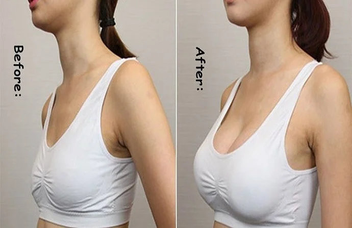 AFT Breast Augmentation before and after