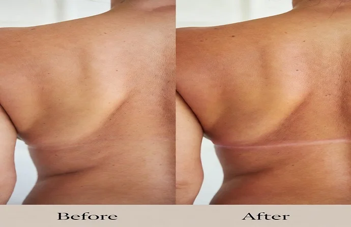 Bra line lift surgery before and after