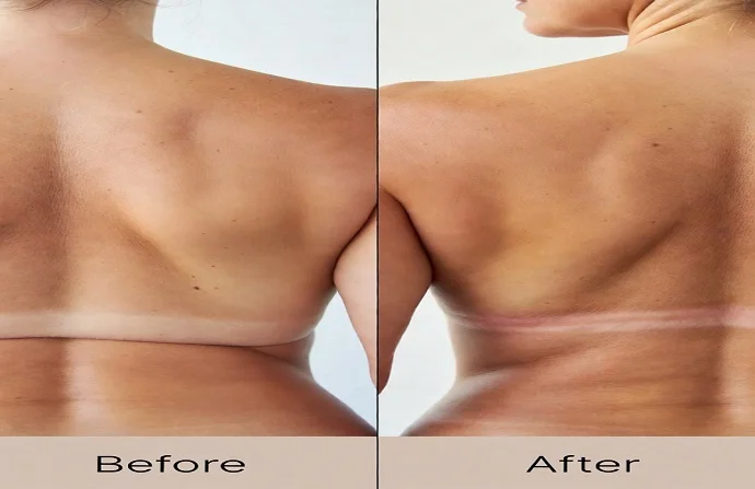 Bra line lift surgery before and after