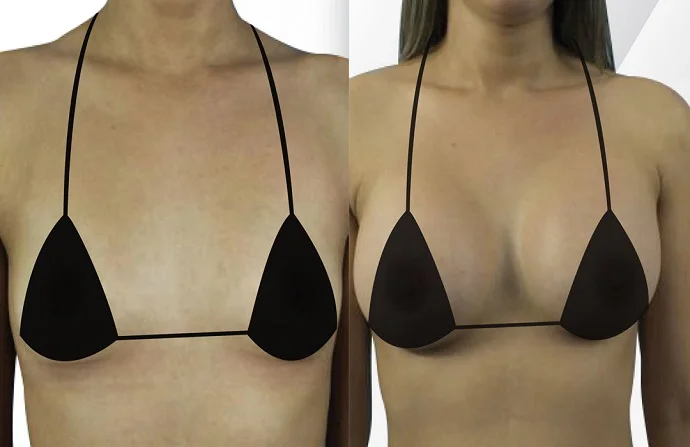 Brava breast augmentation before and after