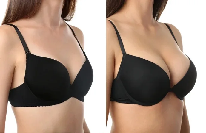 Brava breast augmentation before and after