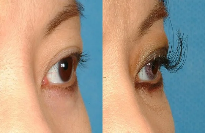 Eyelash Hair Transplant before and after