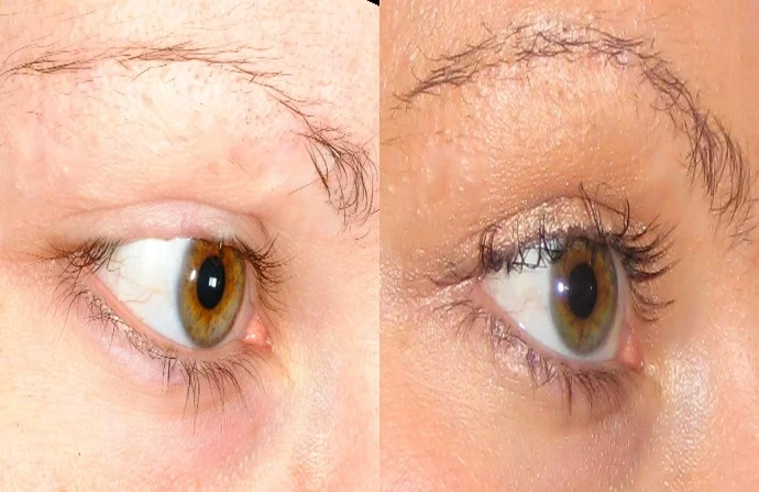 Eyelash Hair Transplant before and after