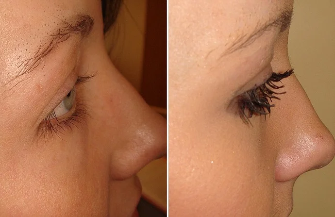 Eyelash Hair Transplant before and after