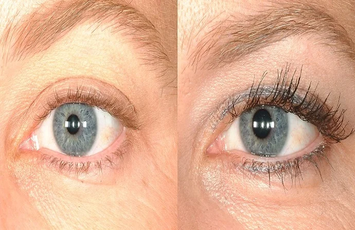 Eyelash Hair Transplant before and after
