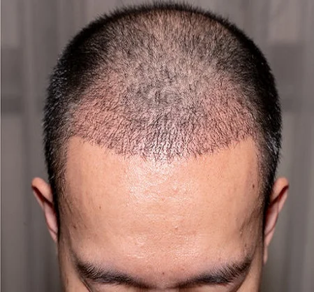 Scarless Hair Transplant in Dubai