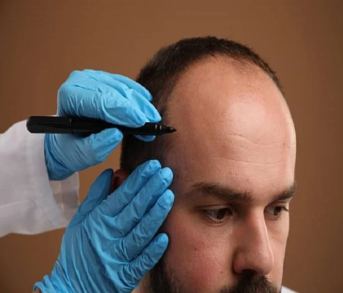 Scarless Hair Transplant in Dubai