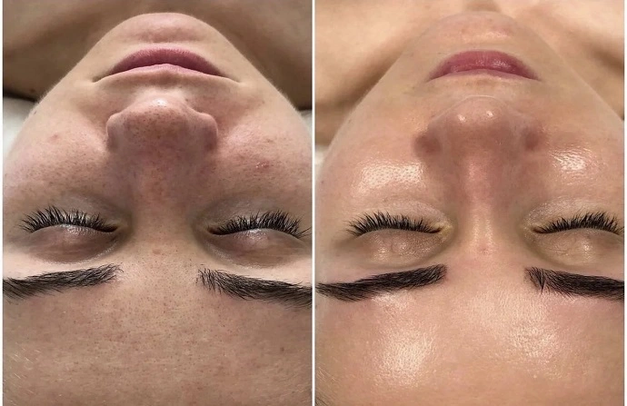 oxygen facial before and after