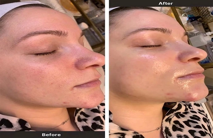 oxygen facial before and after