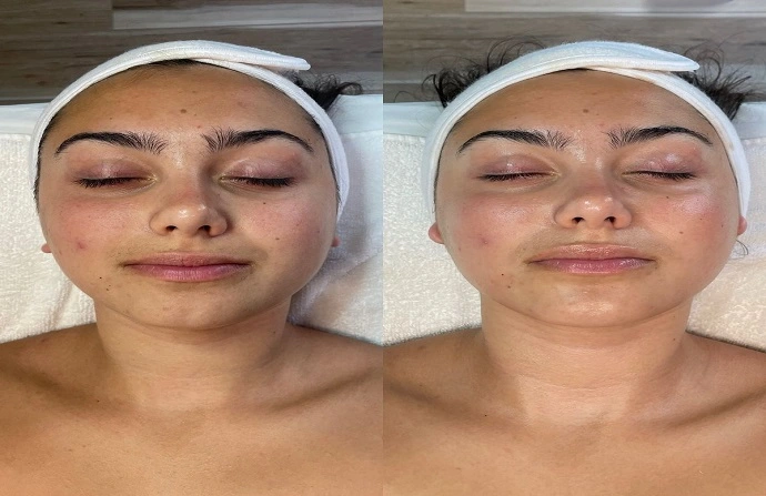 oxygen facial before and after
