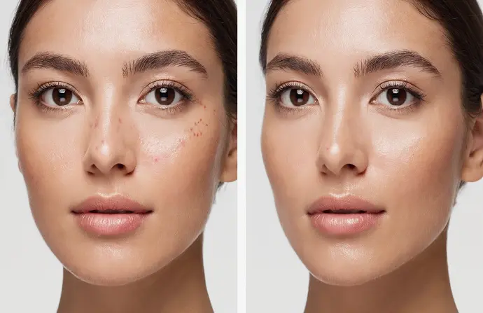 BB Glow Treatment before after