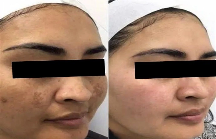 Glutathione IV Drip before after