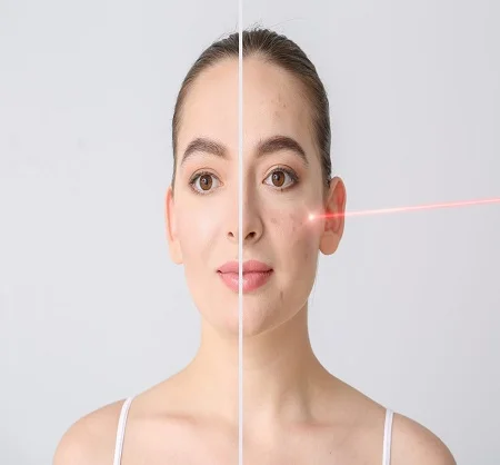 Laser Facial Treatments in Dubai