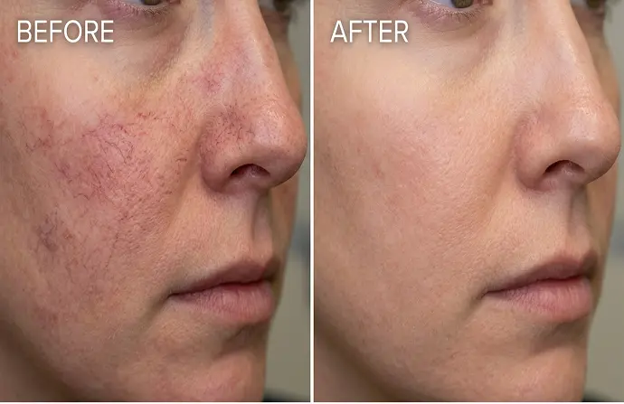 Facial Capillary Treatment in Dubai before after