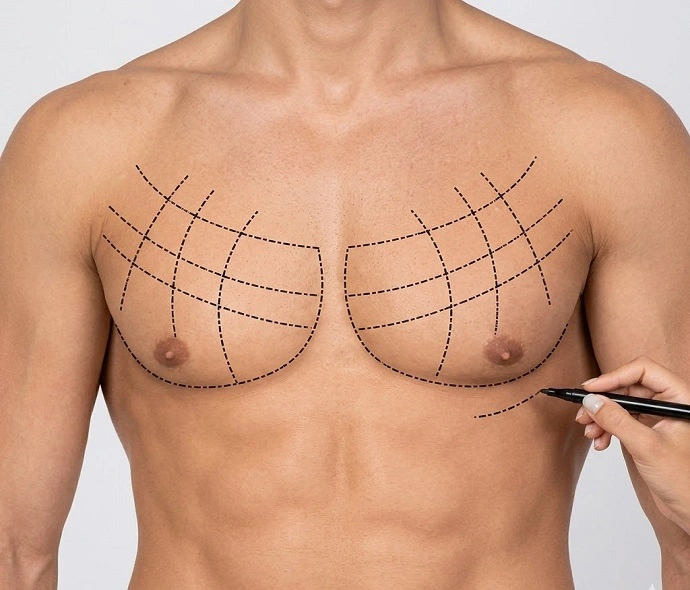 Lipo Chest Surgery in Dubai
