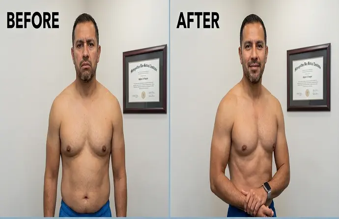 Lipo Chest Surgery in Dubai before after