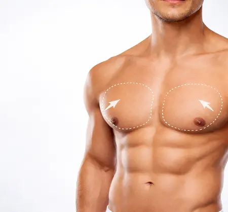 Pectoral Implant Surgery in Dubai