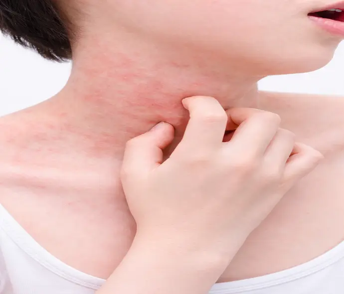 Skin Rashes Treatment in Dubai