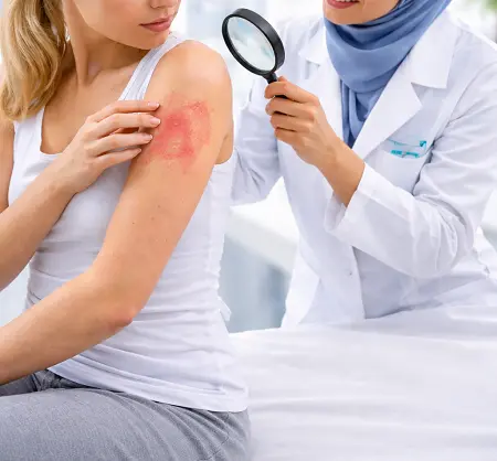 Skin Rashes Treatment in Dubai
