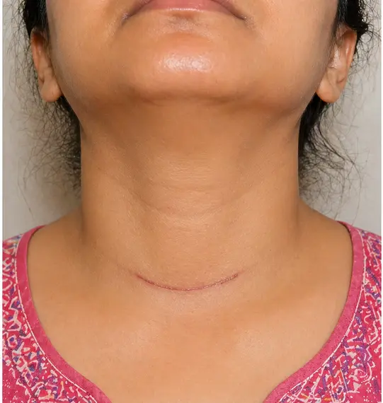 Thyroidectomy in Dubai