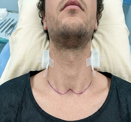 Thyroidectomy in Dubai