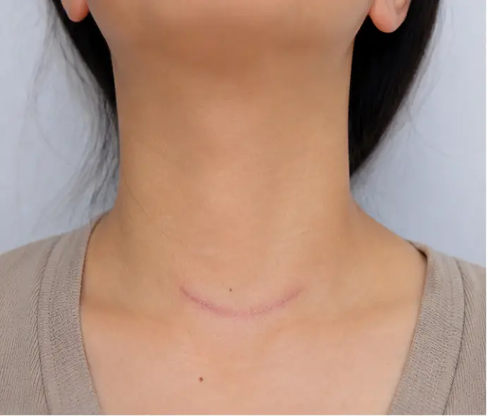 Thyroidectomy in Dubai