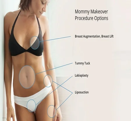 Mommy Makeover Dubai