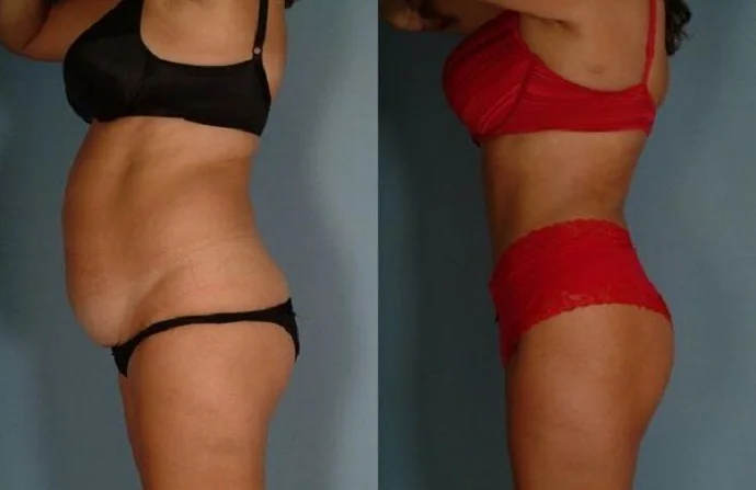 Mommy Makeover before and after