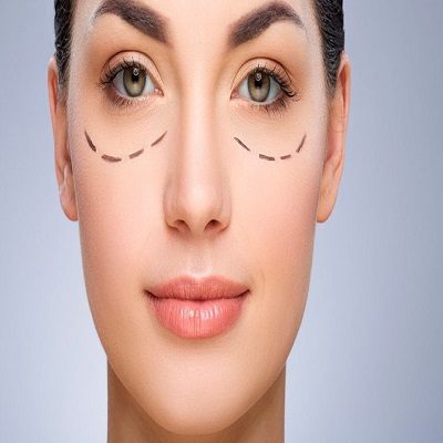 Blepharoplasty​ Surgery in Dubai