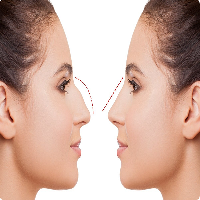 Closed Rhinoplasty