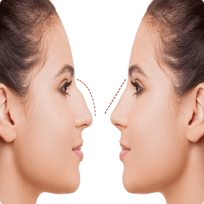 Closed Rhinoplasty