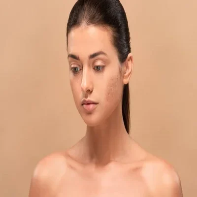 Facial Scar Revision Facial Scar Revision Cost in Dubai