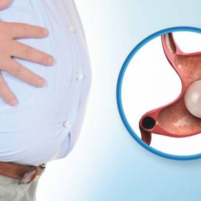 Gastric Balloon Cost in Dubai