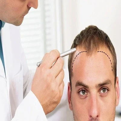 how much does hair transplantation cost in the UAE