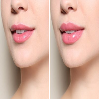 Lip Augmentation Cost in Dubai