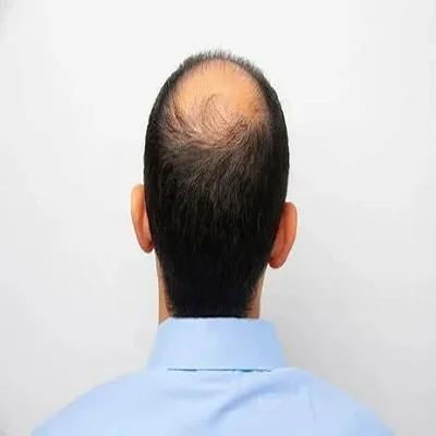 Cost of Effective Male Baldness Treatment in Dubai