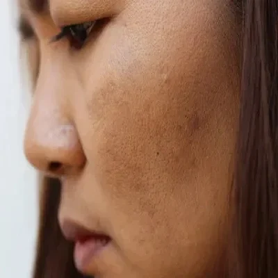 Skin Glow Injections for Hyperpigmentation and Dark Circles