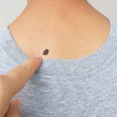 Skin Lession Removal Cost in Dubai