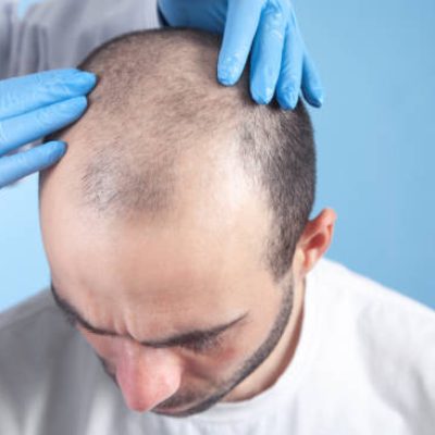 Hair transplant Cost in Dubai