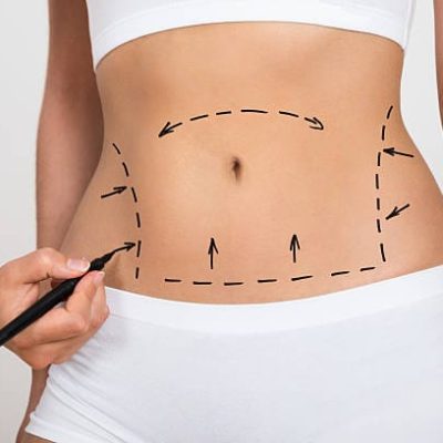 Liposuction surgery in Dubai