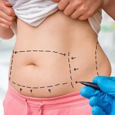 Liposuction surgery in Dubai