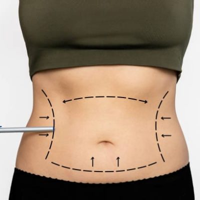 Liposuction surgery in Dubai
