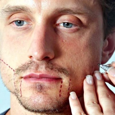 Beard Hair Transplant in Dubai