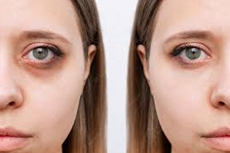 أصبحت الهالات السوداء في دبي وأبو ظبي