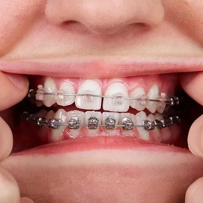 أفضل تقويم الأسنان المعدني في دبي وأبو ظبي والشارقة والعين
